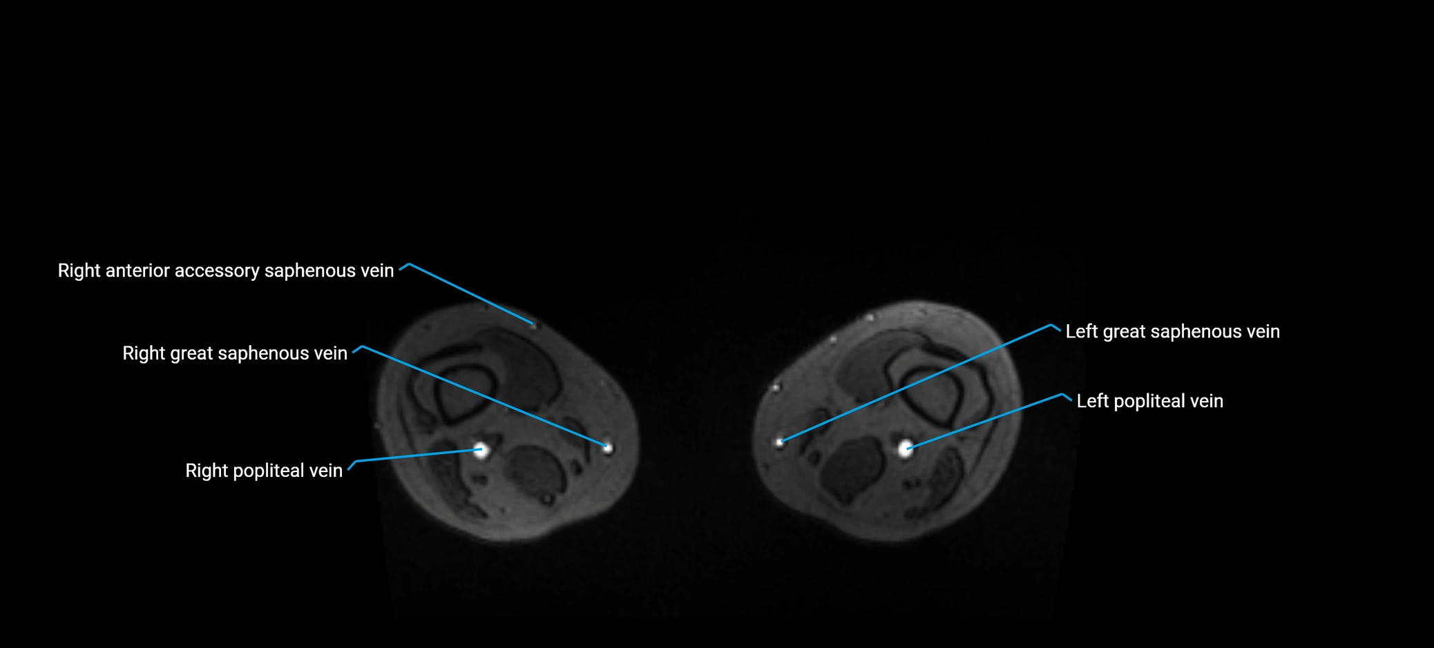 MRV abdomen pelvis & lower limb axial cross sectional anatomy labelled MRI image 339.webp